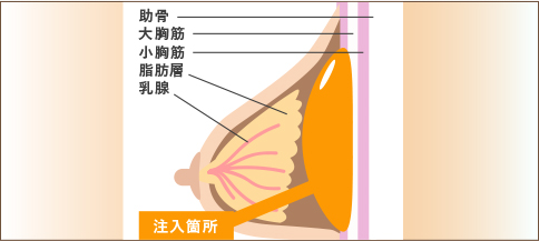 ピュアグラフト豊胸術