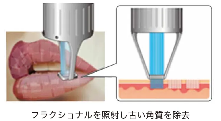 フラクショナを照射し古い角質を除去