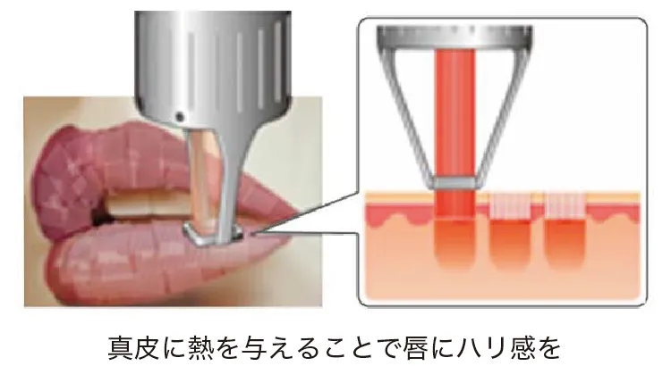 真皮に熱を与えることで唇にハリ感を