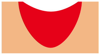 CO2レーザー説明図