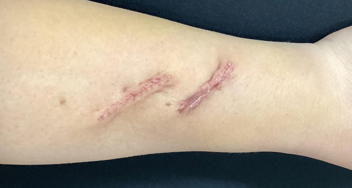 1週間後（抜糸後）