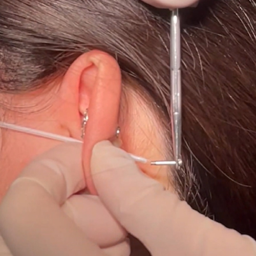 施術（ニードル）