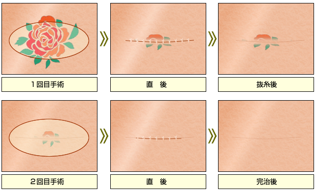 タトゥー分割切除