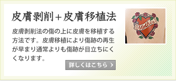 皮膚剥削＋皮膚移植法。皮膚剥削法の傷の上に皮膚を移植する方法です。皮膚移植により傷跡の再生が早まり通常よりも傷跡が目立ちにくくになります。